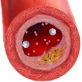 Holesterol in diabetes- razumevanje »slabega« holesterola